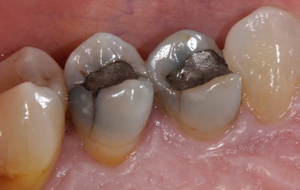Cracked Premolar Teeth