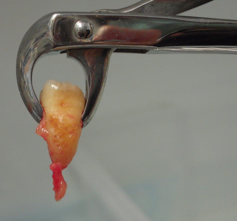 Extracted tooth with abcess